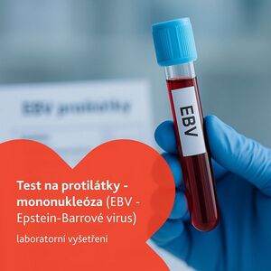 Test na protilátky - mononukleóza laboratorní vyšetření obraz